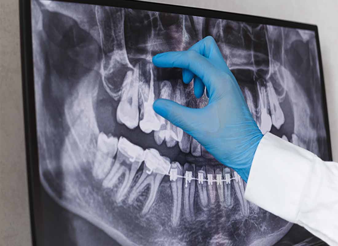 Vital Pulpa Tedavilerinde Biyoseramik Materyallerin Kullanımı: Sistematik Derleme